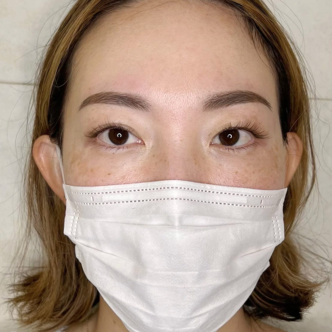 正面お顔全体 目を開けているアフター